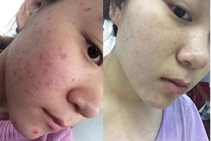 怎么樣才能去痘痘 去除痘痘有效方法