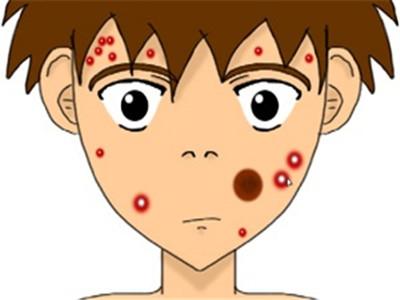激光祛痘的原理和副作用（激光祛痘必看）
