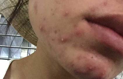 學幾招去除粉刺小妙招 讓你的臉各個部位都干干凈凈