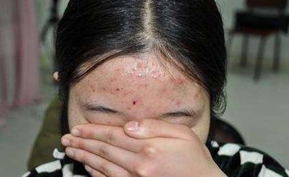 粉刺和痘痘有什么區別 去除粉刺痘痘有哪些方法