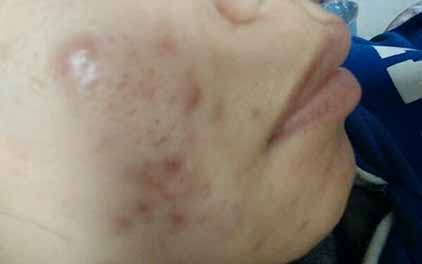 臉上長的硬痘痘怎么能快速消除 六個妙招祛除硬痘痘