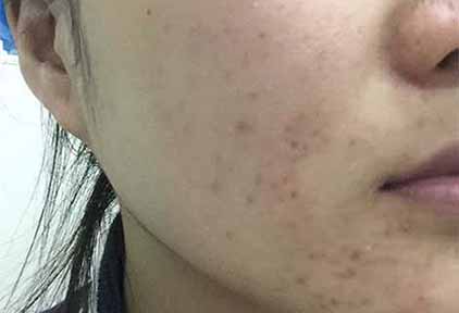 巧用黃瓜去痘印小方法 快速有效的去除痘痘留下的痘印