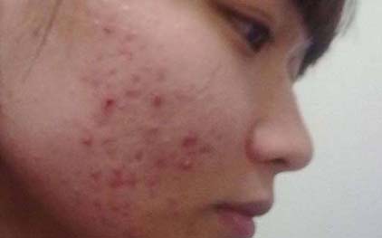 青春痘總是消不去 不妨試試這7個青春痘的治療方法