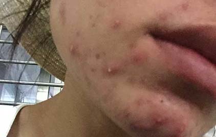 下巴長痘痘怎么辦 怎么才能去掉下巴上的痘痘