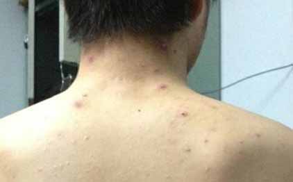 背上有痘痘怎么辦