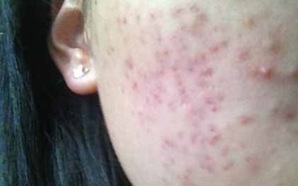 痘痘怎么快速消除小妙招