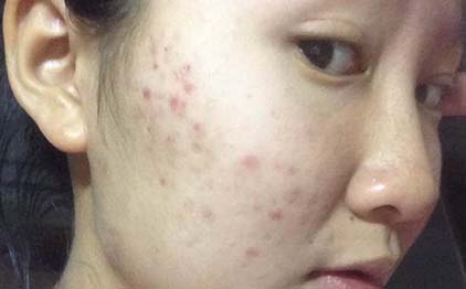 臉上長痘痘了怎么辦