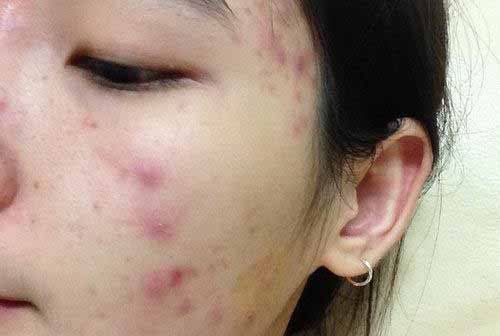 治療青春痘的小妙招