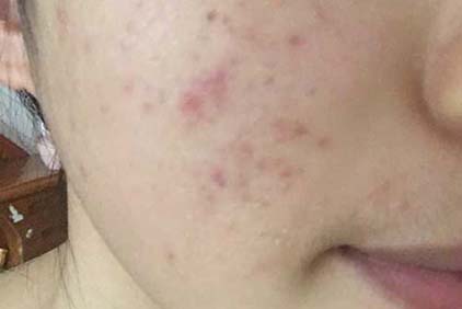 【怎么去痘印簡單有效】去痘印小妙招塑嫩白肌膚