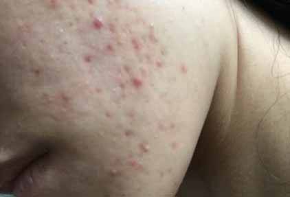 /冬季吃火鍋長痘怎么辦 祛痘小妙招讓你祛痘無憂