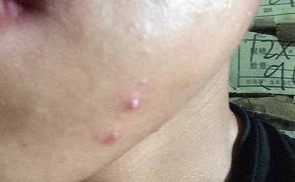 經常對著電腦會長痘痘嗎 防輻射祛痘護膚方法預防長痘痘