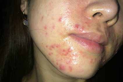 【嘴角長痘痘怎么辦】內調外養祛痘美顏擺脫痘痘肌膚