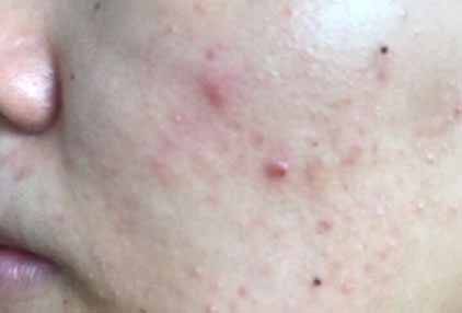 生理期長痘痘怎么辦 經期護膚方法重塑健康肌膚