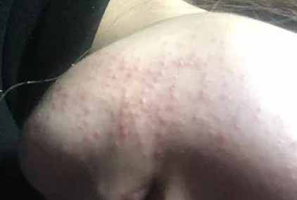 油性皮膚長痘痘怎么辦 關于油性皮膚一些很好用的護膚祛痘方法