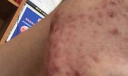 /臉上長痘痘怎么辦 不同部位長痘痘的原因及祛痘方法