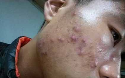 /臉上長痘痘不知道怎么調理 護膚老師帶你深究長痘痘的原因及祛痘方法