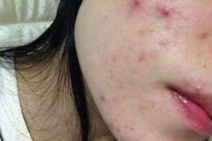20多歲一臉痘印 進來教你怎樣祛痘去痘印和制作去痘印面膜