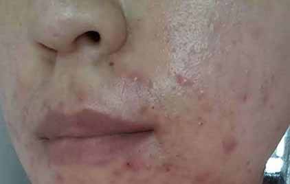 長了痘痘如何祛痘護膚才好?日常生活中很多有效的護膚小竅門拒絕痘痘反復
