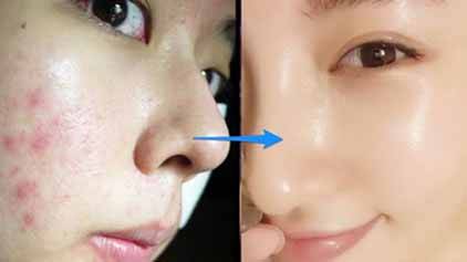 /痘痘粉刺怎么消除 四招輕松去除痘痘粉刺問題肌膚