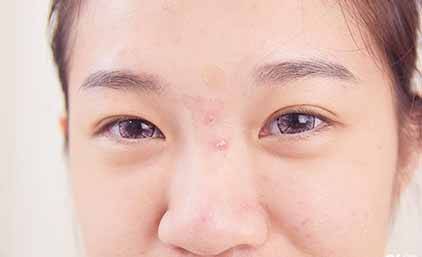 祛痘老師告訴你四個個日常生活中去青春痘最有效方法