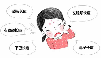 臉上不同部位長痘痘的原因和快速祛痘的簡單方法