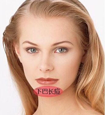 下巴長痘痘護理方法